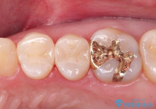 昔の詰め物のなかで広がる虫歯。セラミックインレー