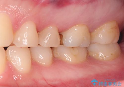 昔の詰め物のなかで広がる虫歯。セラミックインレーの治療後