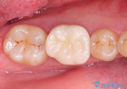 奥歯が痛い。根管治療~オールセラミッククラウンの治療後