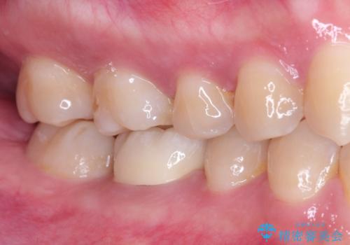 奥歯が痛い。根管治療~オールセラミッククラウンの治療後