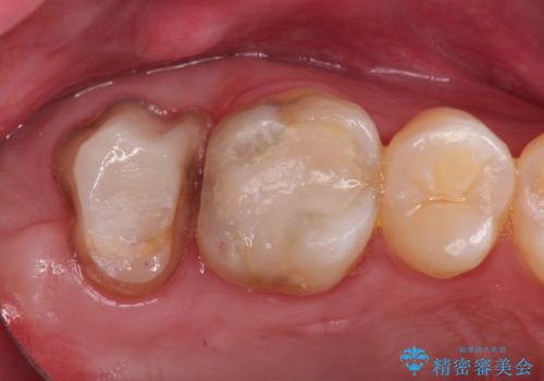 歯肉に埋もれたマージンライン 奥歯の被せものの治療中