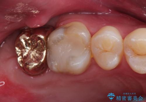 歯肉に埋もれたマージンライン 奥歯の被せものの治療後