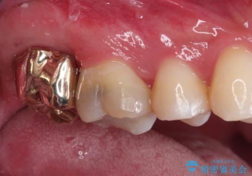 歯肉に埋もれたマージンライン 奥歯の被せものの治療後