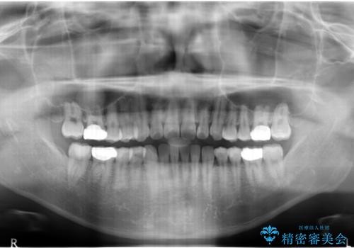 前歯のねじれ 上だけ部分矯正でコストダウンの治療後