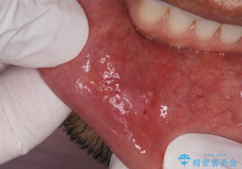 唇を噛んでしまった 粘液嚢胞の摘出の治療後