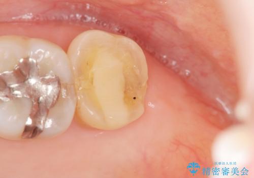 歯周外科で整備する安定したクラウン環境の治療前