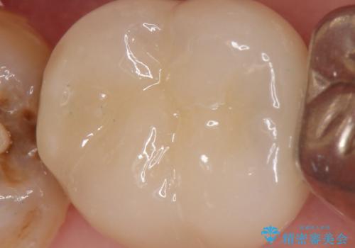 [銀歯の下の虫歯 ] 根管治療を伴う虫歯治療の症例 治療後