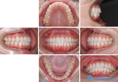 留学前に矯正治療 目立たないワイヤー装置でのスピード矯正の治療後