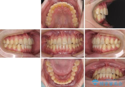 前歯のクロスバイト インビザラインによる矯正治療の治療後