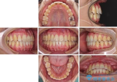 矯正歯科治療と前歯の歯肉移植術の治療後