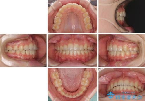 乳歯が残っている 目立たない装置での抜歯矯正の治療後