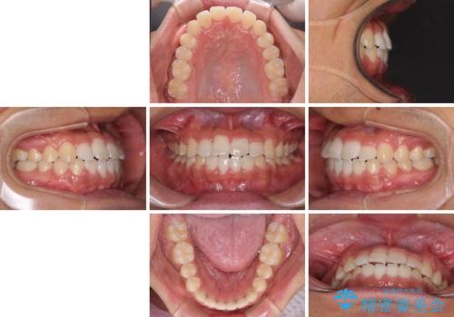 美容歯科でも断られた 著しい前歯のクロスバイトをワイヤー矯正で改善の治療後