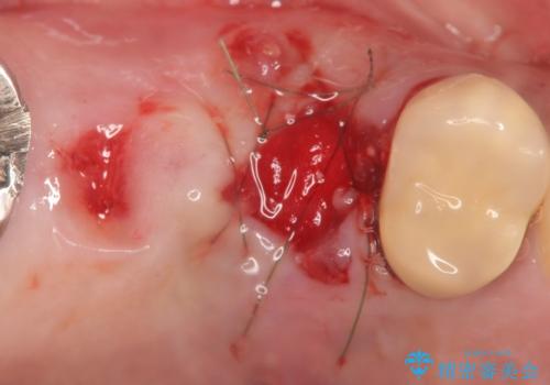 インプラント(ストローマン) 抜歯後の欠損補綴の治療後
