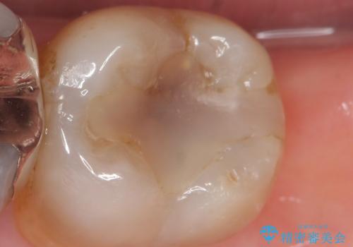 臼歯部 長期的に予知性の高いゴールドインレーへの治療前