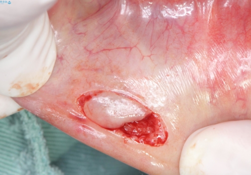 唇を噛んでしまった 粘液嚢胞の摘出の治療中