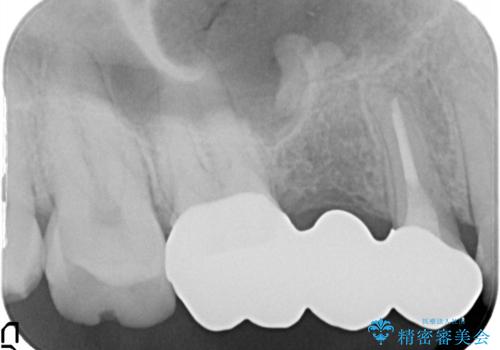 根管治療からのオールセラミックブリッジ装着の治療後