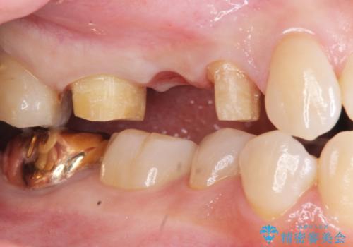 虫歯による歯の喪失　ジルコニアブリッジの製作の治療中
