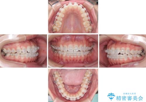 留学前に矯正治療 目立たないワイヤー装置でのスピード矯正の治療中