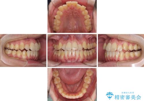前歯のクロスバイト インビザラインによる矯正治療の治療中