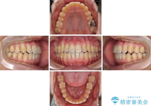 矯正歯科治療と前歯の歯肉移植術の治療中