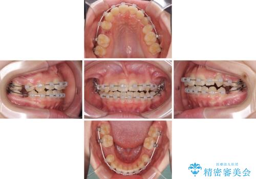 乳歯が残っている 目立たない装置での抜歯矯正の治療中