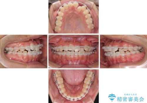 美容歯科でも断られた 著しい前歯のクロスバイトをワイヤー矯正で改善の治療中