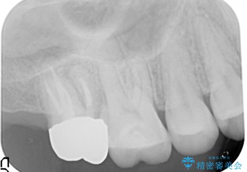 歯肉に埋もれたマージンライン 奥歯の被せものの治療後