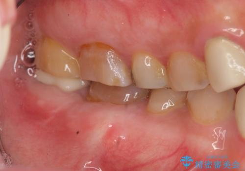 歯ぎしりによる異常に低い歯冠高径 　歯周外科による解決の治療後
