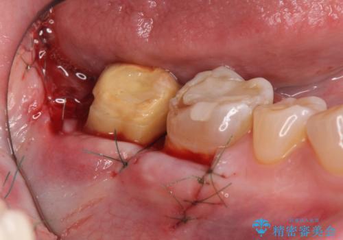 歯ぎしりによる異常に低い歯冠高径 歯周外科による解決の治療中