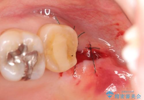 歯周外科で整備する安定したクラウン環境の治療前