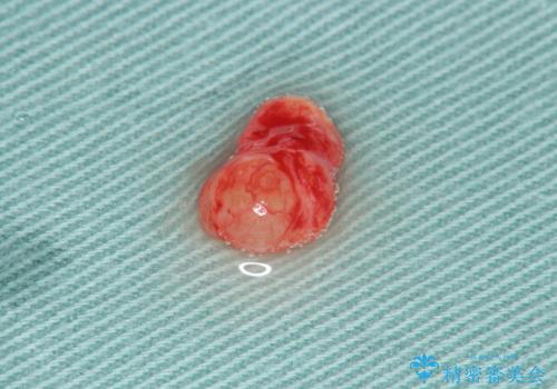 唇を噛んでしまった 粘液嚢胞の摘出の治療中