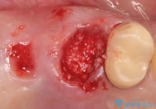 インプラント(ストローマン) 抜歯後の欠損補綴の治療中
