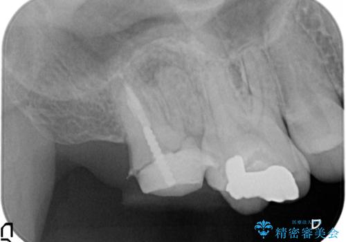 歯肉に埋もれたマージンライン　奥歯の被せものの治療前