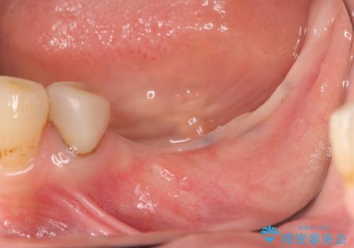 インプラントで咬合機能を取り戻すの症例 治療前