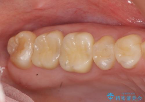 [フルジルコニアクラウン] 老朽化した銀歯を白くの症例 治療後