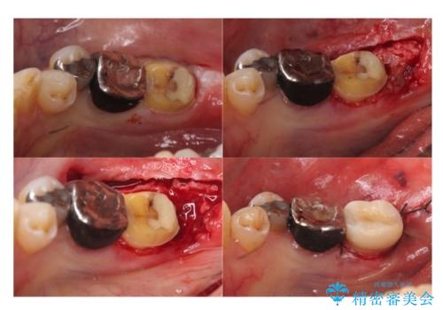 下の奥歯の虫歯 歯周外科手術を含めた治療の治療中