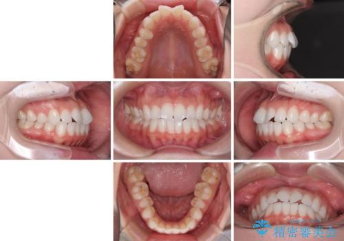 留学前に矯正治療 目立たないワイヤー装置でのスピード矯正の治療前
