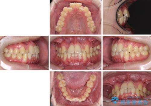 前歯のクロスバイト　インビザラインによる矯正治療の治療前