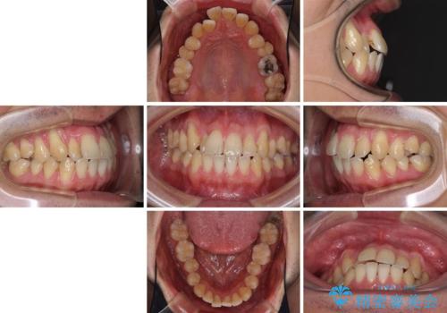 矯正歯科治療と前歯の歯肉移植術の治療前