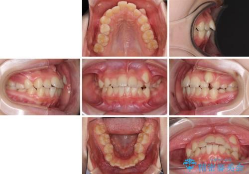 乳歯が残っている 目立たない装置での抜歯矯正の治療前