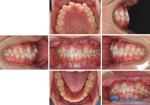 美容歯科でも断られた 著しい前歯のクロスバイトをワイヤー矯正で改善の治療前