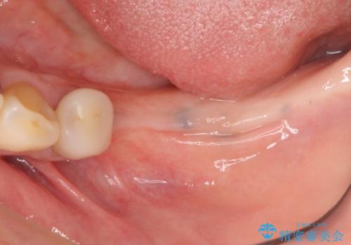 インプラントで咬合機能を取り戻すの治療前