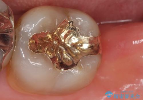 臼歯部　長期的に予知性の高いゴールドインレーへの症例 治療後