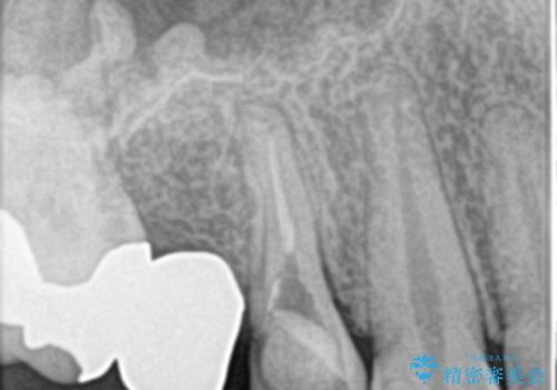 根管治療からのオールセラミックブリッジ装着の治療前