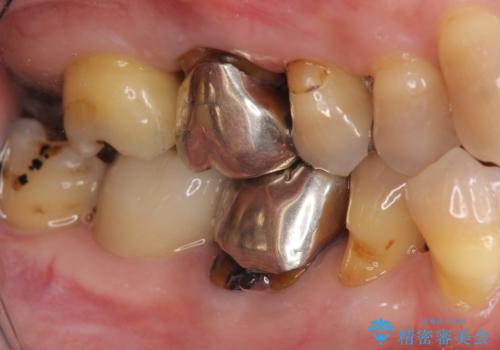 [銀歯の下の虫歯 ] 根管治療を伴う虫歯治療の治療後
