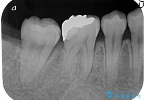 奥歯が痛い。根管治療~オールセラミッククラウンの治療前
