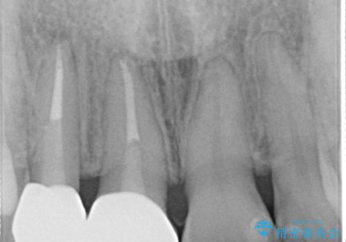前歯が痛い。根管治療~オールセラミッククラウンの治療後