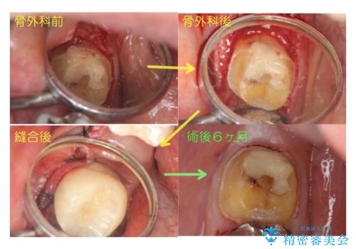 下の奥歯の虫歯 歯周外科手術を含めた治療の治療中