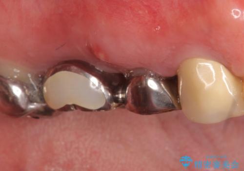 インプラント(ストローマン) 抜歯後の欠損補綴の治療前