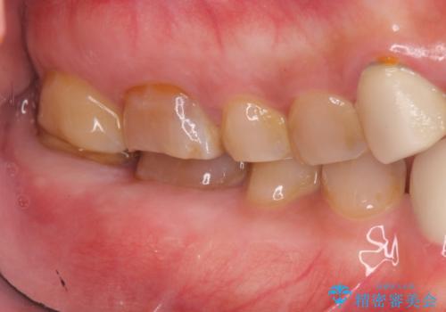 歯ぎしりによる異常に低い歯冠高径  歯周外科による解決